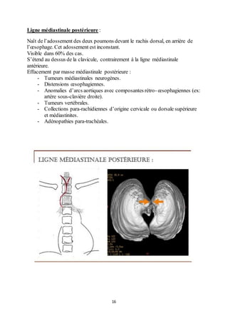 16
Ligne médiastinale postérieure :
Naît de l’adossement des deux poumons devant le rachis dorsal, en arrière de
l’œsophage. Cet adossement est inconstant.
Visible dans 60% des cas.
S’étend au dessus de la clavicule, contrairement à la ligne médiastinale
antérieure.
Effacement par masse médiastinale postérieure :
- Tumeurs médiastinales neurogènes.
- Distensions œsophagiennes.
- Anomalies d’arcs aortiques avec composantes rétro- œsophagiennes (ex:
artère sous-clavière droite).
- Tumeurs vertébrales.
- Collections para-rachidiennes d’origine cervicale ou dorsale supérieure
et médiastinites.
- Adénopathies para-trachéales.
 