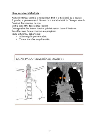 17
Ligne para-trachéale droite :
Naît de l’interface entre le lobe supérieur droit et le bord droit de la trachée.
À gauche, le poumonreste à distance de la trachée du fait de l’interposition de
l’aorte et des vaisseaux du cou.
Visible dans 65% des cas chez l’adulte.
Correspond en fait à une « bande » qui doit rester < 5mm d’épaisseur.
Son effacement évoque : tumeur œsophagienne.
Si elle est élargie, cela évoque :
- Adénomégalie para-trachéale.
- Tumeur trachéale ou pulmonaire.
 