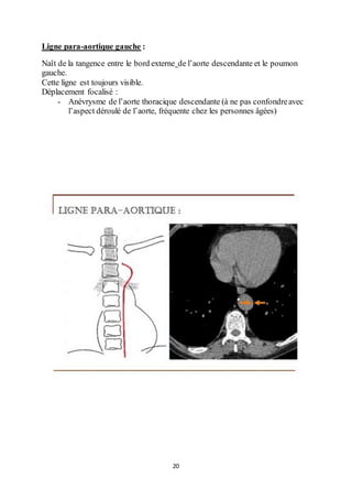 20
Ligne para-aortique gauche :
Naît de la tangence entre le bord externe de l’aorte descendante et le poumon
gauche.
Cette ligne est toujours visible.
Déplacement focalisé :
- Anévrysme de l’aorte thoracique descendante (à ne pas confondreavec
l’aspect déroulé de l’aorte, fréquente chez les personnes âgées)
 