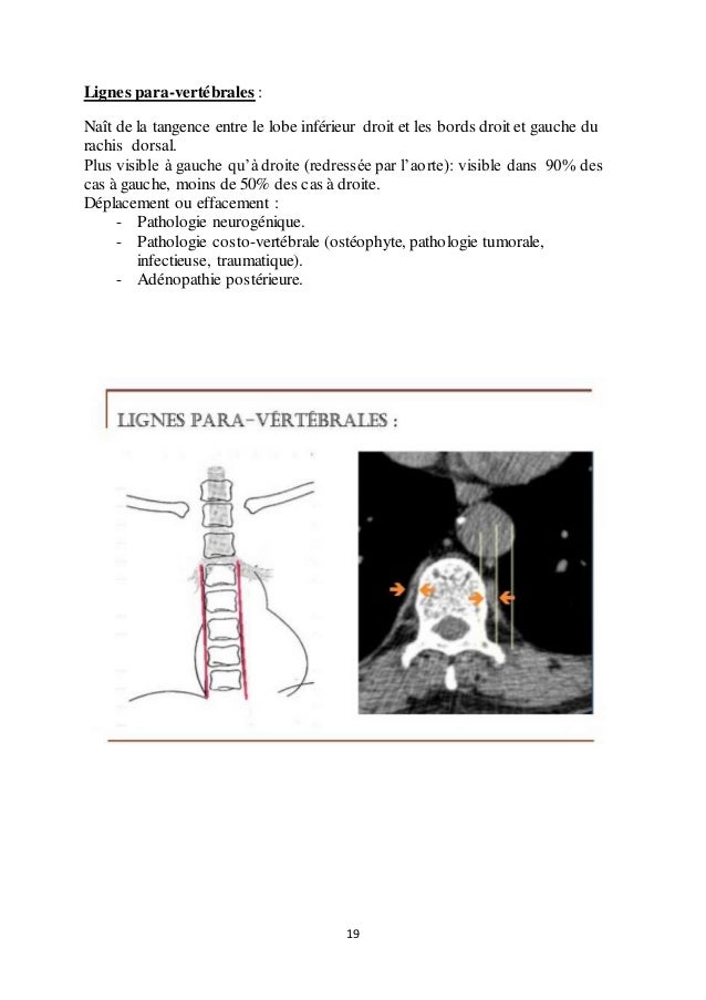 Tumeur Neurognique Blogger
