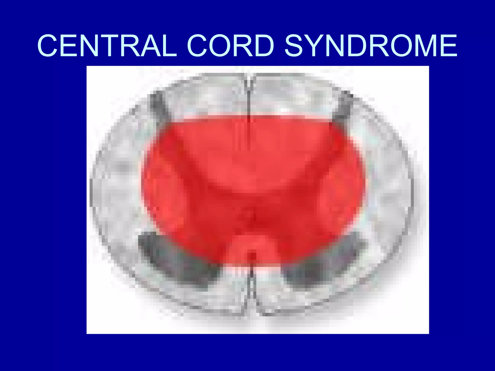 Syndromes Of Spinal Cord | PPT