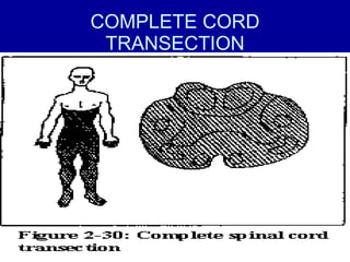 COMPLETE CORD TRANSECTION 