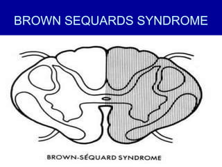 BROWN SEQUARDS SYNDROME 