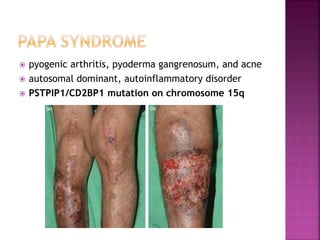 Ra Pyoderma Syndromic Acne | PPTX
