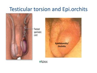 Testicular torsion and Epi.orchits
Epididymitis/
Orchitis
 