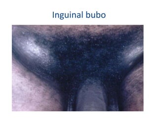 Inguinal bubo
 