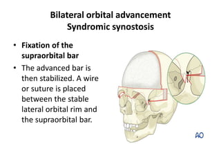 Syndromic cranial synostosis | PPTX