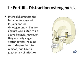 Internal Distractor Syndromic cranial synostosis | PPTX