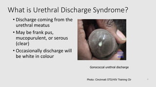 What is Urethral Discharge Syndrome?
• Discharge coming from the
urethral meatus
• May be frank pus,
mucopurulent, or serous
(clear)
• Occasionally discharge will
be white in colour
Gonococcal urethral discharge
Photo: Cincinnati STD/HIV Training Ctr 8
 