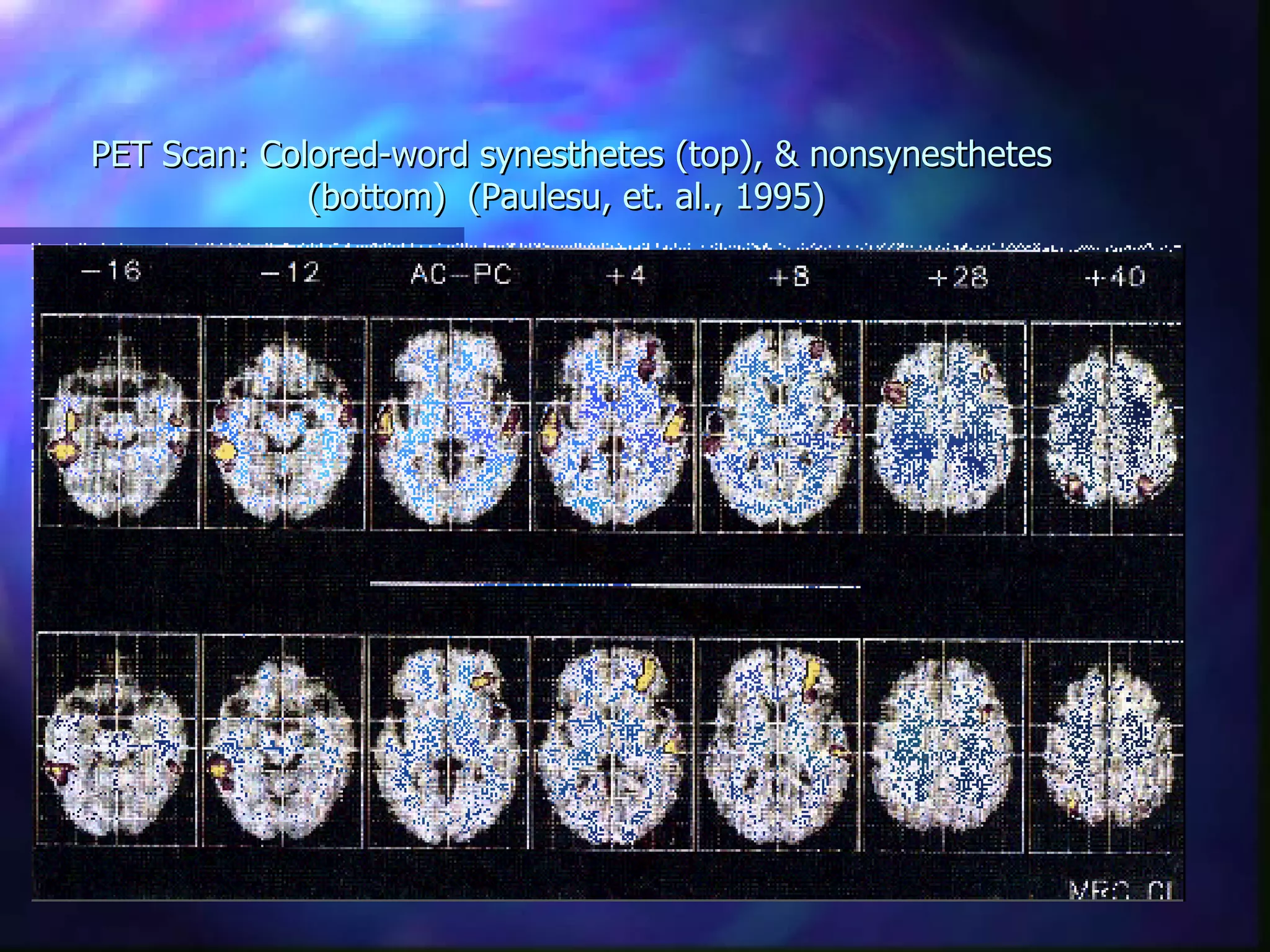 PET Scan: Colored-word synesthetes (top), & nonsynesthetes (bottom)  (Paulesu, et. al., 1995)  