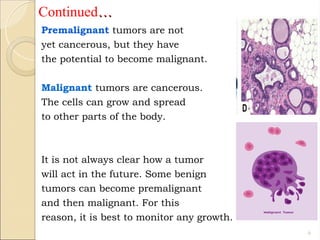 EARLY DETECTION AND CLASSIFICATION OF BREAST CANCER USING MAMMOGRAMS ...