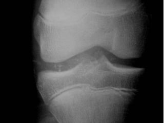 Quinker Synovial Chondromatosis | PPTX