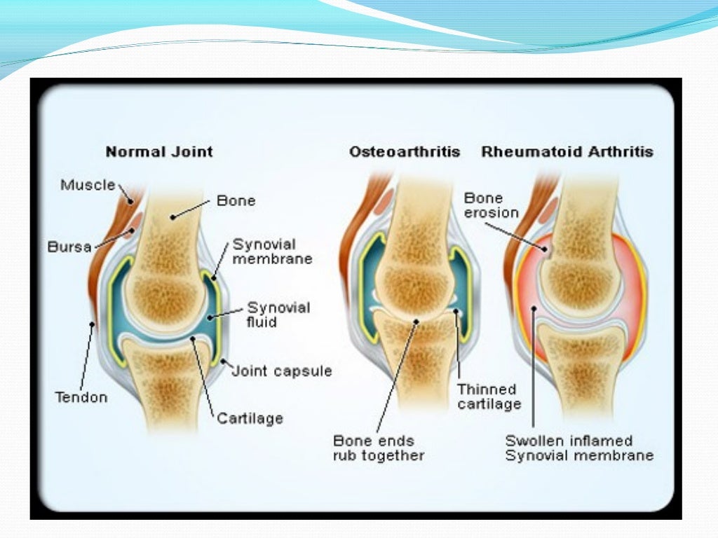 infected synovial fluid color infected synovial fluid color