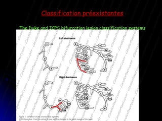 Classification préexistantes The Duke and ICPS bifurcation lesion classification systems 