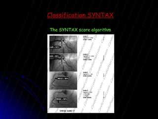 Classification SYNTAX The SYNTAX score algorithm 