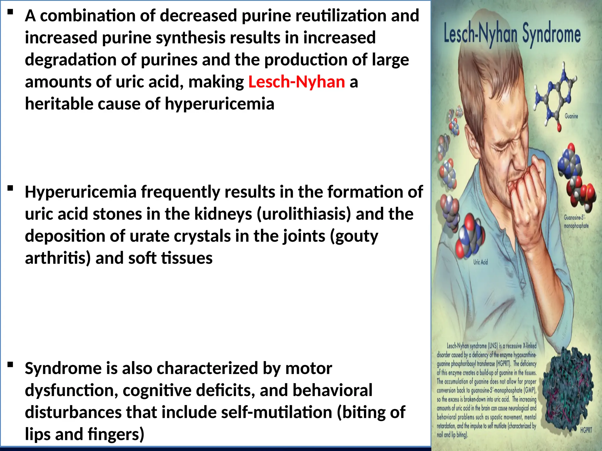  A combination of decreased purine reutilization and
increased purine synthesis results in increased
degradation of purines and the production of large
amounts of uric acid, making Lesch-Nyhan a
heritable cause of hyperuricemia
 Hyperuricemia frequently results in the formation of
uric acid stones in the kidneys (urolithiasis) and the
deposition of urate crystals in the joints (gouty
arthritis) and soft tissues
 Syndrome is also characterized by motor
dysfunction, cognitive deficits, and behavioral
disturbances that include self-mutilation (biting of
lips and fingers)
 