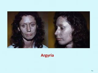 69
Argyria
 