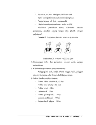 19 | K e p e r a w a t a n M u s k u l o s k e l e t a l 2
Tekankan jari pada arteri proksimal dari luka
Bebat tekan pada seluruh ekstremitas yang luka
Pasang tampon sub fasia (gauza pack)
Hindari tourniquet (torniquet = usaha terakhir)
Perdarahan permukaan tubuh ekstremitas lakukan
penekanan, gunakan sarung tangan atau plastik sebagai
pelindung !
Gambar 3. Perdarahan dan cara menekan perdarahan
Perdarahan 20 cc/menit = 1200 cc / jam
4. Pemasangan infus dan pergantian volume darah dengan
cairan/darah.
5. Cari sumber perdarahan yang tersembunyi
Rongga perut (hati, limpa, arteri), rongga pleura, panggul
atau pelvis, tulang paha (femur), kulit kepala (anak)
6. Lokasi dan Estimasi perdarahan
Fraktur femur tertutup : 1,5-2 liter
Fraktur tibia tertutup : 0,5 liter
Fraktur pelvis : 3 liter
Hemothorak : 2 liter
Fraktur iga (tiap satu) : 150 cc
Luka sekepal tangan : 500 cc
Bekuan darah sekepal : 500 cc
 