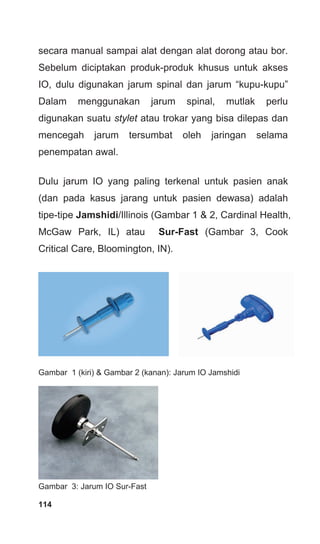 secara manual sampai alat dengan alat dorong atau bor.
Sebelum diciptakan produk-produk khusus untuk akses
IO, dulu digunakan jarum spinal dan jarum “kupu-kupu”
Dalam menggunakan jarum spinal, mutlak perlu
digunakan suatu stylet atau trokar yang bisa dilepas dan
mencegah jarum tersumbat oleh jaringan selama
penempatan awal.
Dulu jarum IO yang paling terkenal untuk pasien anak
(dan pada kasus jarang untuk pasien dewasa) adalah
tipe-tipe Jamshidi/Illinois (Gambar 1 & 2, Cardinal Health,
McGaw Park, IL) atau Sur-Fast (Gambar 3, Cook
Critical Care, Bloomington, IN).
Gambar 1 (kiri) & Gambar 2 (kanan): Jarum IO Jamshidi
Gambar 3: Jarum IO Sur-Fast
114
 