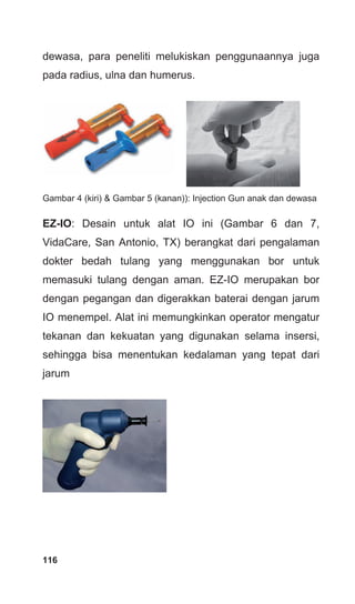 dewasa, para peneliti melukiskan penggunaannya juga
pada radius, ulna dan humerus.
Gambar 4 (kiri) & Gambar 5 (kanan)): Injection Gun anak dan dewasa
EZ-IO: Desain untuk alat IO ini (Gambar 6 dan 7,
VidaCare, San Antonio, TX) berangkat dari pengalaman
dokter bedah tulang yang menggunakan bor untuk
memasuki tulang dengan aman. EZ-IO merupakan bor
dengan pegangan dan digerakkan baterai dengan jarum
IO menempel. Alat ini memungkinkan operator mengatur
tekanan dan kekuatan yang digunakan selama insersi,
sehingga bisa menentukan kedalaman yang tepat dari
jarum
116
 