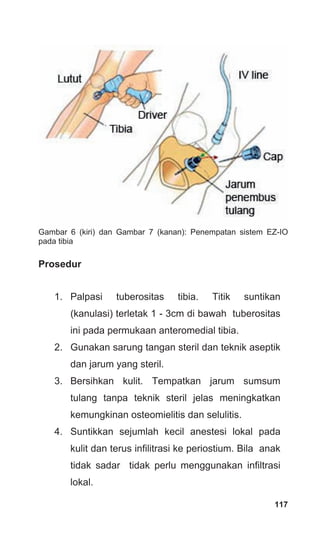 Gambar 6 (kiri) dan Gambar 7 (kanan): Penempatan sistem EZ-IO
pada tibia
Prosedur
1. Palpasi tuberositas tibia. Titik suntikan
(kanulasi) terletak 1 - 3cm di bawah tuberositas
ini pada permukaan anteromedial tibia.
2. Gunakan sarung tangan steril dan teknik aseptik
dan jarum yang steril.
3. Bersihkan kulit. Tempatkan jarum sumsum
tulang tanpa teknik steril jelas meningkatkan
kemungkinan osteomielitis dan selulitis.
4. Suntikkan sejumlah kecil anestesi lokal pada
kulit dan terus infilitrasi ke periostium. Bila anak
tidak sadar tidak perlu menggunakan infiltrasi
lokal.
117
 