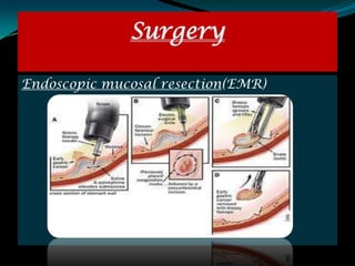 Surgery

Endoscopic mucosal resection(EMR)
 