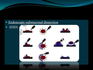  Endoscopic submucosal dissection
 (ESD)
 