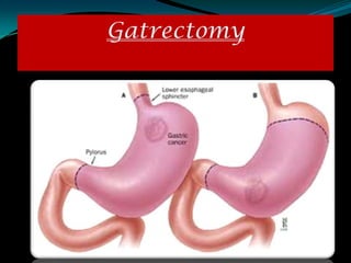 Gatrectomy
 