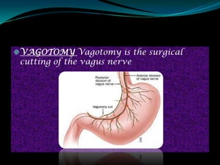 VAGOTOMY Vagotomy is the surgical
 cutting of the vagus nerve
 
