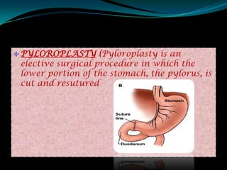 PYLOROPLASTY (Pyloroplasty is an
elective surgical procedure in which the
lower portion of the stomach, the pylorus, is
cut and resutured
 
