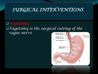 SURGICAL INTERVENTIONS


 vagotomy
Vagotomy is the surgical cutting of the
 vagus nerve
 