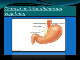 Truncal or total abdominal
vagotomy
 