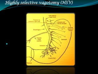 Highly selective vagotomy (HSV)





 