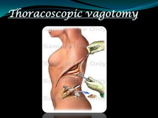 Thoracoscopic vagotomy
 