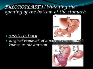 PYLOROPLASTY (Widening the
opening of the bottom of the stomach




 ANTRECTOMY
 surgical removal, of a part of the stomach
 known as the antrum
 