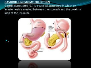 GASTROJEJUNOSTOMY(BILLROTH 2)
Gastrojejunostomy (GJ) is a surgical procedure in which an
anastomosis is created between the stomach and the proximal
loop of the jejunum.




.
 