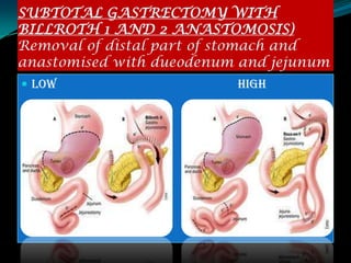 SUBTOTAL GASTRECTOMY WITH
BILLROTH 1 AND 2 ANASTOMOSIS)
Removal of distal part of stomach and
anastomised with dueodenum and jejunum
 LOW                     HIGH
 