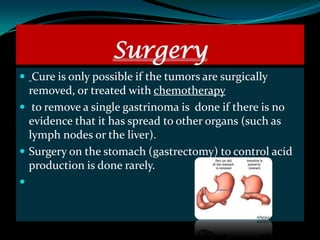 Surgery
 Cure is only possible if the tumors are surgically
  removed, or treated with chemotherapy
 to remove a single gastrinoma is done if there is no
  evidence that it has spread to other organs (such as
  lymph nodes or the liver).
 Surgery on the stomach (gastrectomy) to control acid
  production is done rarely.

 