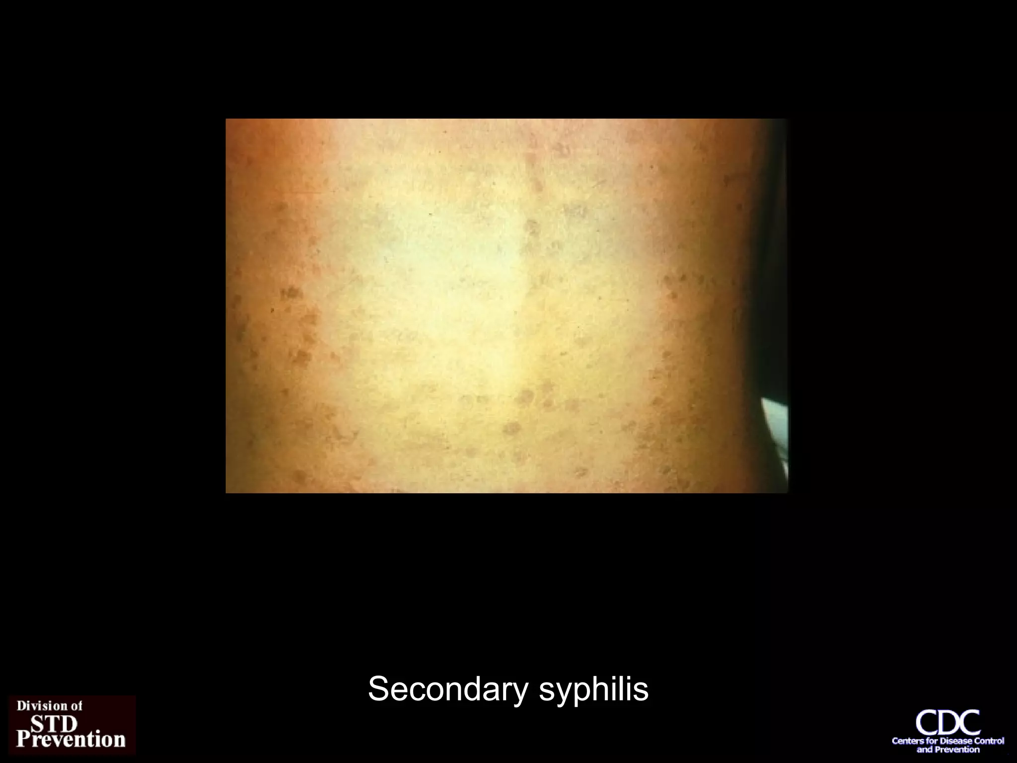 Syphilis