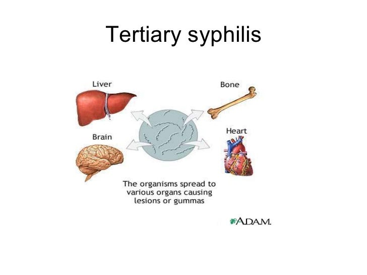 Syphilis and Neurosyphilis 101 rhinitis diagram 