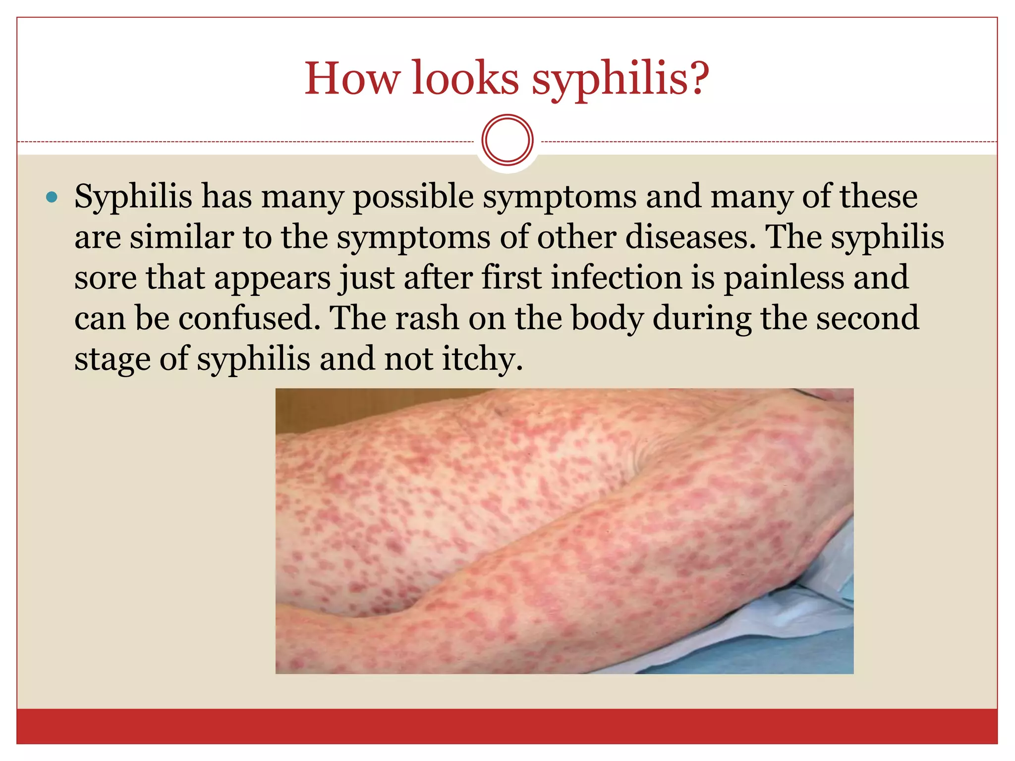 How looks syphilis?
 Syphilis has many possible symptoms and many of these
are similar to the symptoms of other diseases. The syphilis
sore that appears just after first infection is painless and
can be confused. The rash on the body during the second
stage of syphilis and not itchy.
 