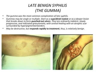 Syphilis | PPT