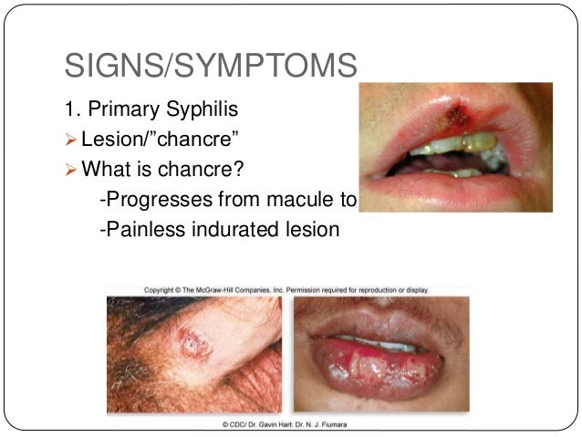 Syphilis Syphilis