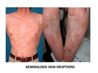 Syphilis Diffuse Rash Syphilis | PPSX
