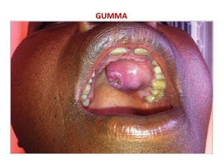 Semga Infection syphilis-20022315561hhyggtytggg0 (1).pdf