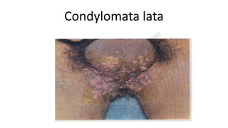 Condylomata lata
 