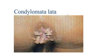 Condylomata lata
 