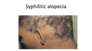 Syphilitic alopecia
 