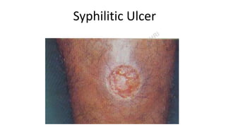 Syphilitic Ulcer
 