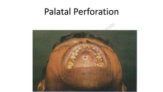 Palatal Perforation
 